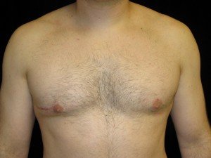 Reasons For Gynecomastia Revision Surgery Reasons For Gynecomastia Revision Surgery
