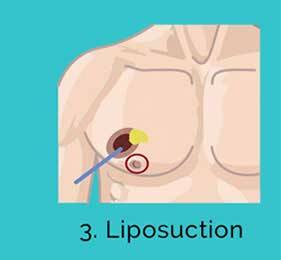 Enlarged Breasts In Men (Gynecomastia) - Symptoms And Causes Gynecomastia Treatment Liposuction Phase
