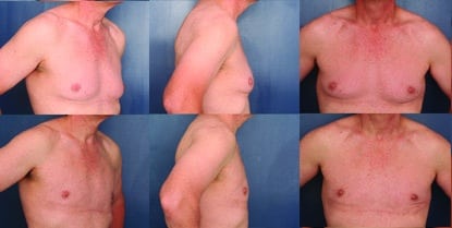 Before And After Gynecomastia Surgery By Doctor Ronald Schuster