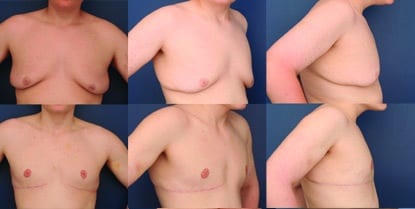 Before And After Gynecomastia Surgery By Doctor Ronald Schuster