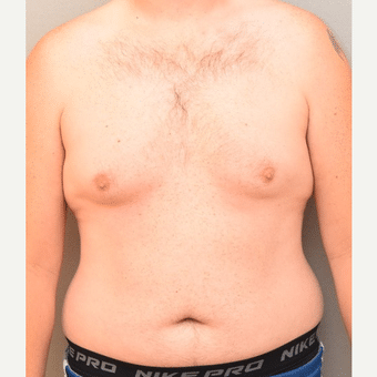 25 Questions To Ask At Your Gynecomastia Consultation
