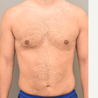 Man After Breast Reduction