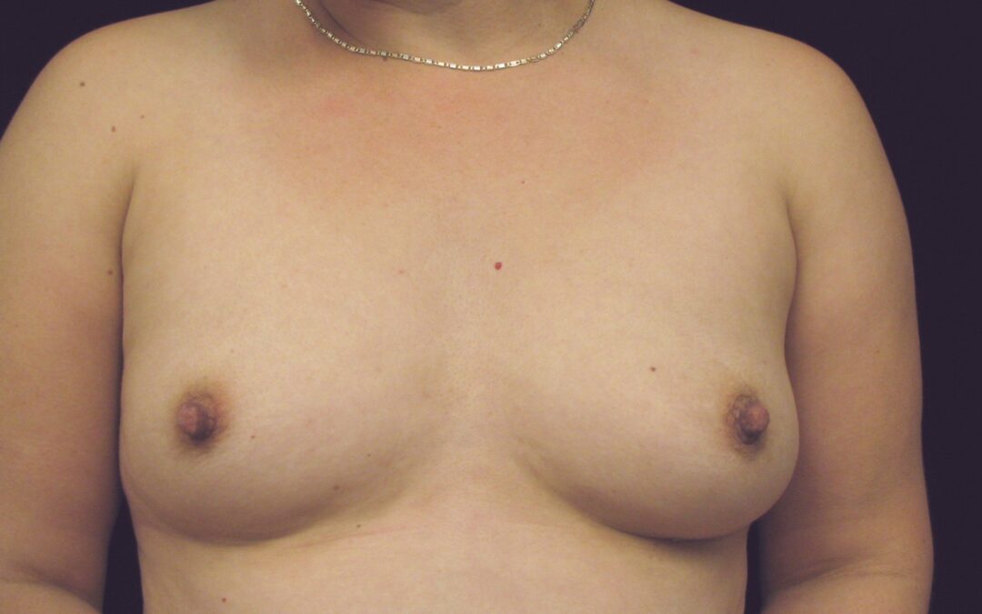 Psychiatric Drugs Can Cause Gynecomastia