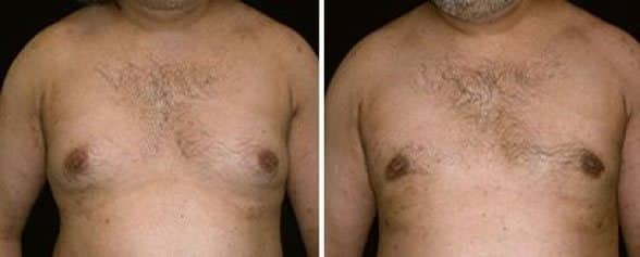 Pseudogynecomastia Example Of Pseudogynecomastia
