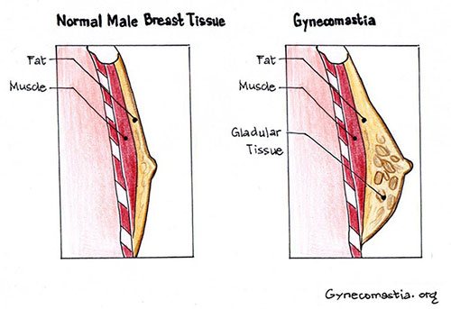 Symptoms Of Adolescent Gynecomastia Signs And Symptoms Of Adolescent Gynecomastia
