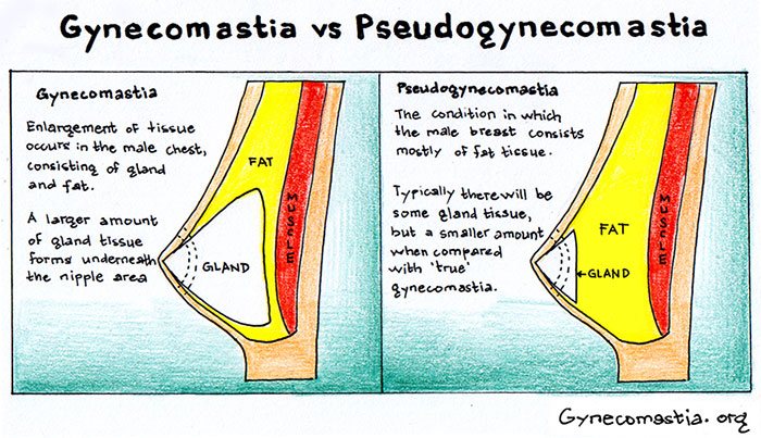 Gynecomsatia-Vs-Pseudogynecomastia Gynecomsatia Vs Pseudogynecomastia