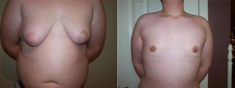 Teen Gynecomastia Understanding Teenage Gynecomastia
