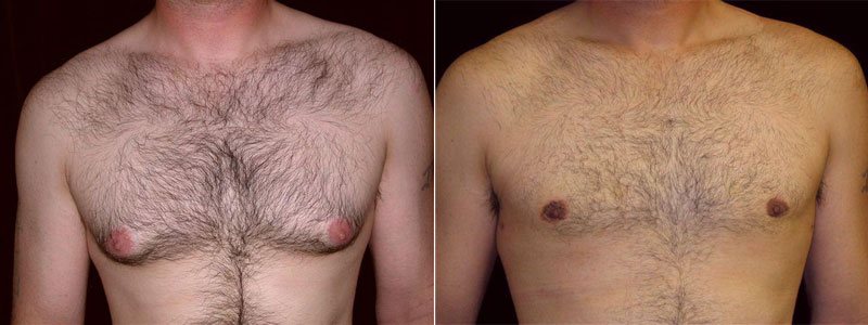 Teenage Gynecomastia Signs Of Adolescent Gynecomastia