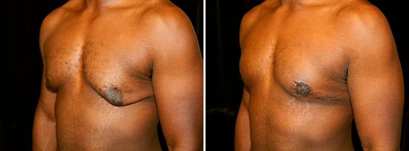 Signs And Symptoms Of High Estrogen (Gynecomastia): Diagnosis, Treatment, And More Gynecomastia Before And After Estrogen