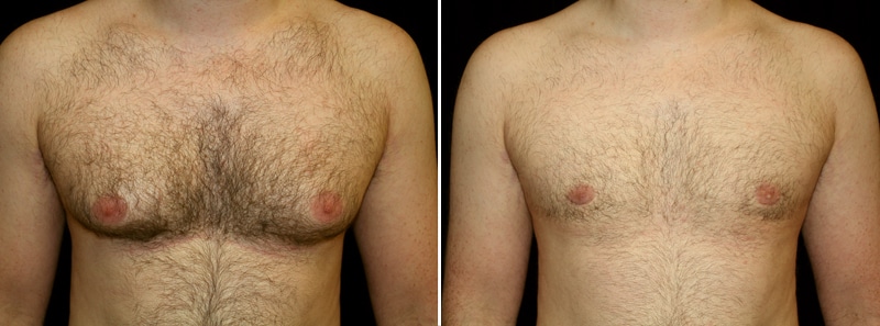 gynecomastia before and after gynecomastia before and after