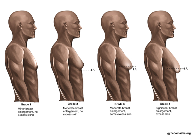 Gynecomastia.org Grades 1 - 4 Of Gynecomastia Gynecomastia.org Grades 1 - 4 Of Gynecomastia